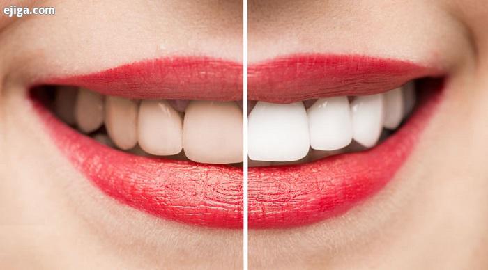 روشهای سفید کردن دندان در منزل