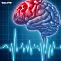 انواع سکته مغزی به زبان ساده/بهترین پزشک مغز و اعصاب برای درمان سکته مغزی