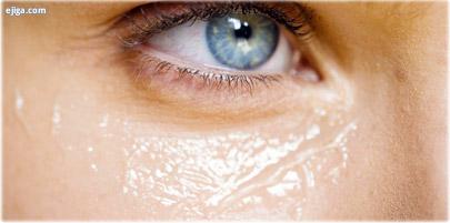 استفاده زیاد از داروهای ضد هموروئید می‌تواند به کاهش پف و کیسه‌های زیر چشم کمک کند.