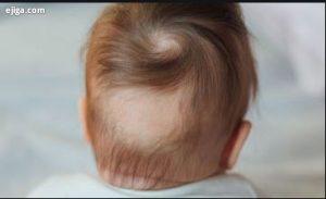 علل ریزش مو در کودک