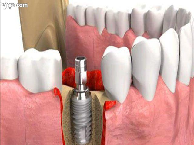 ایمپلنت دندان | انواع ایمپلنت دندان | خطرات و عوارض ایمپلنت دندان