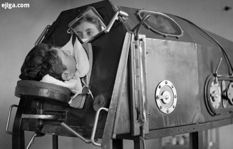 کسانی را که عضلات تنفسی‌شان به دلیل فلج اطفال از کار می‌افتادند در دستگاه ریه آهنی قرار می‌دادند که امکان هر حرکتی را از آنها می‌گرفت